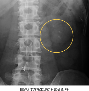 (ESWL(体外衝撃波結石破砕術)後)