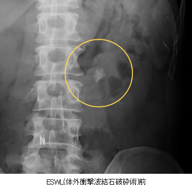 (ESWL(体外衝撃波結石破砕術)前)