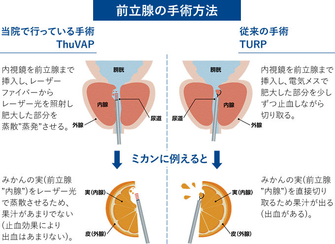 前立腺の手術方法　図