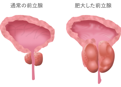 通常の前立腺と肥大した前立腺