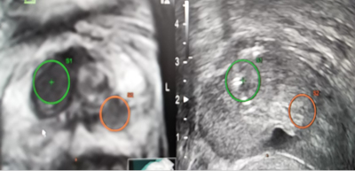(左)MRI画像　　経直腸前立腺超音波画像(右)